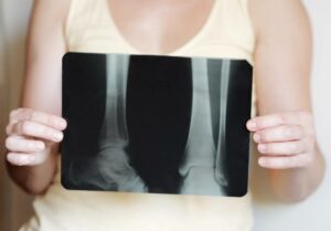 osteoporosi-sintomi-cause-cure